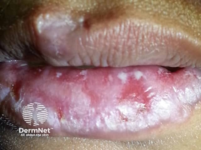 Mucosal CLE