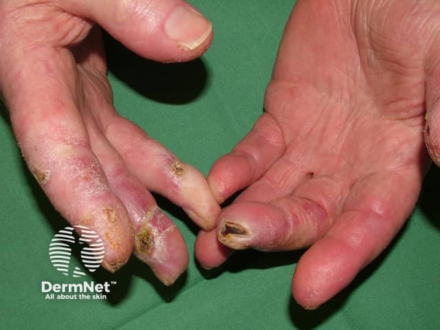 Chilblain lupus