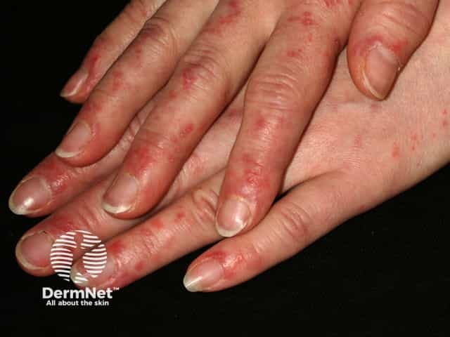 Systemic lupus erythematosus
