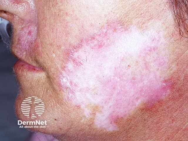 Systemic lupus erythematosus