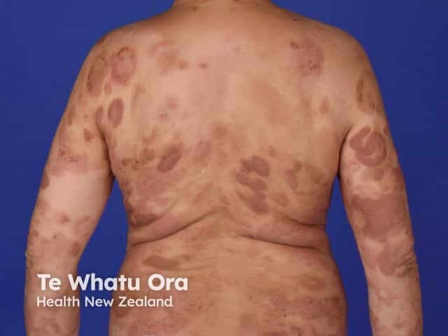 Cutaneous T-cell lymphoma